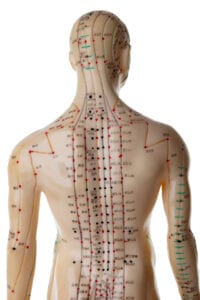 acupuntura, canales acupuntura, migraña